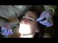 6 Month Smiles Monthly Orthodontic Adjustment - Orlando FL Dentist