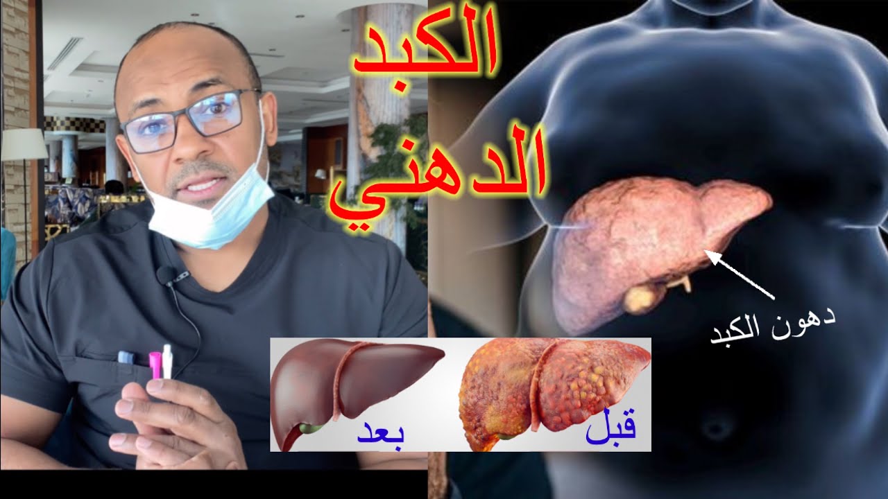 حرق دهون الكبد من المنزل  وب اسهل طريقة