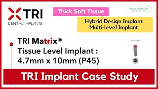 Tri Matrix Implant Case Study 4.7Mm X 10Mm Thick Soft Tissue - Updated Version