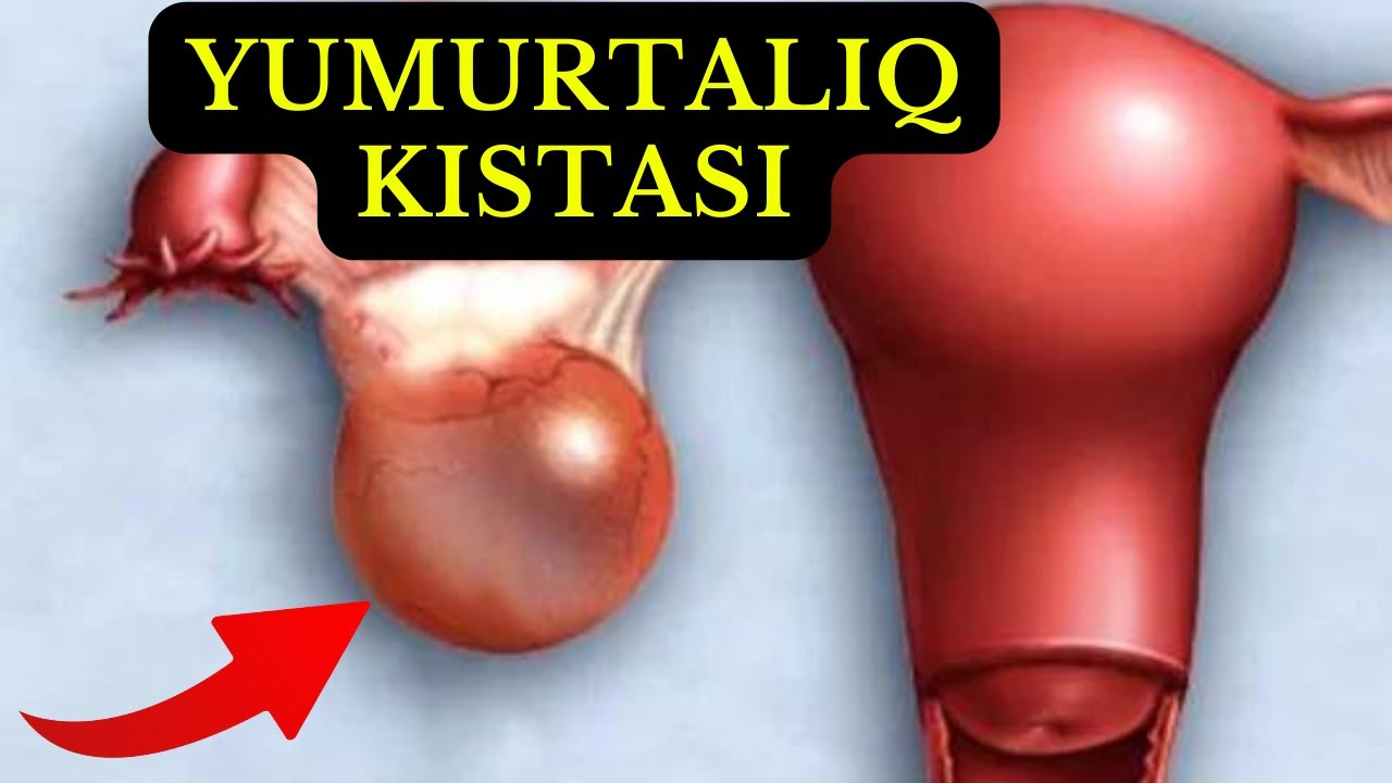 Follekulyar Kista - NƏDİR?