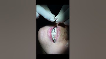 Cách vệ Sinh Răng Miệng Cho Người Niềng Răng Ngày tết| Nha Khoa Minh Châu