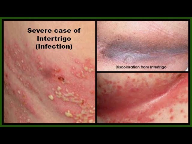 HOW TO TREAT UNDER BREAST + INFECTION NATURALLY IN 4 STEPS INTERTRIGO Beauty - YouTube