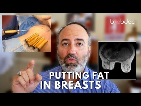 5 Reasons NOT to Inject Fat into Your Breasts - Breast Augmentation with Fat Grafting