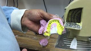 Customizing Stock Impression Trays (Putty Wash Impression Technique)