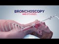 #BRONCHOSCOPY - ITS USES I DR. NAVEEN KUMAR AILAWADI I CHEST SPECIALIST