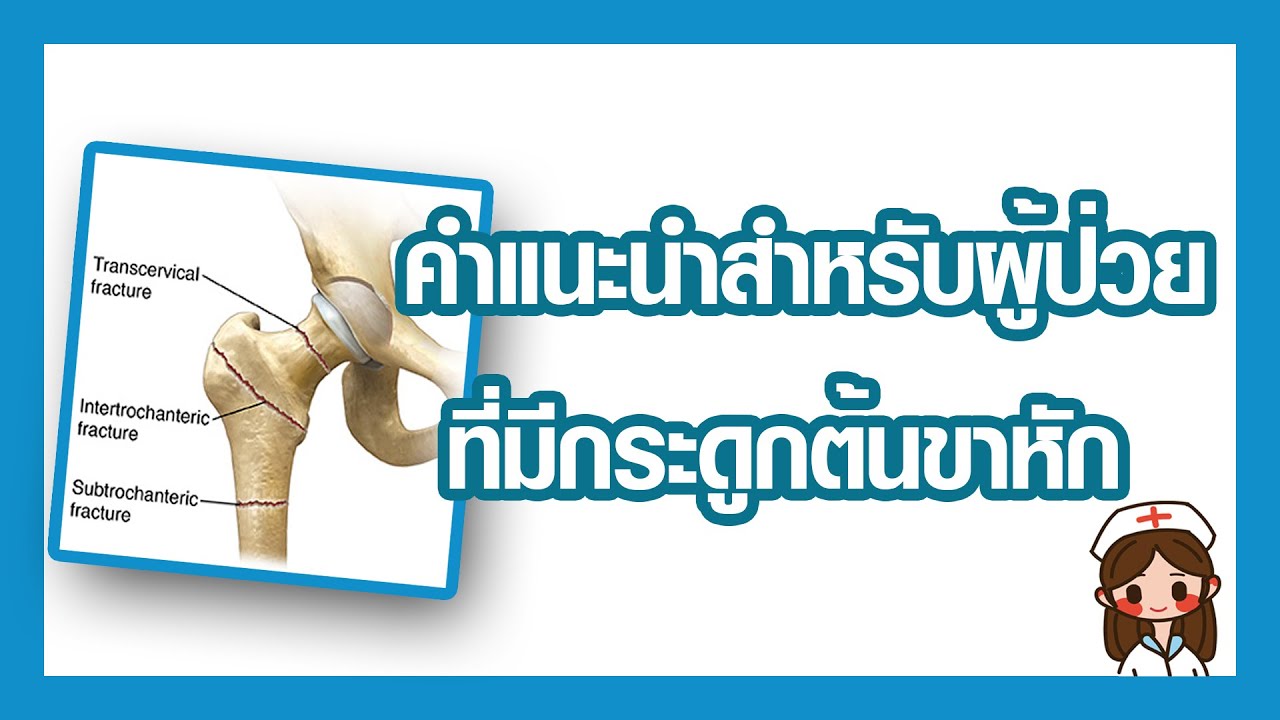 พยาธิ สภาพ กระดูก ต้น ขา หัก  2022  คำแนะนำสำหรับผู้ป่วยที่มีกระดูกต้นขาหัก