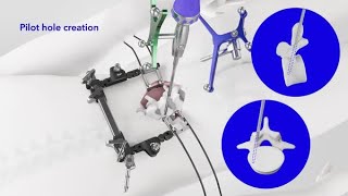 Animation: CD Horizon ™ ModuLeX™  5.5mm Spinal System
