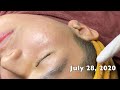 Acne Treatment For "Hung" (P15) | Điều Trị Mụn Cho Hùng (P15)- SacDepSpa#218