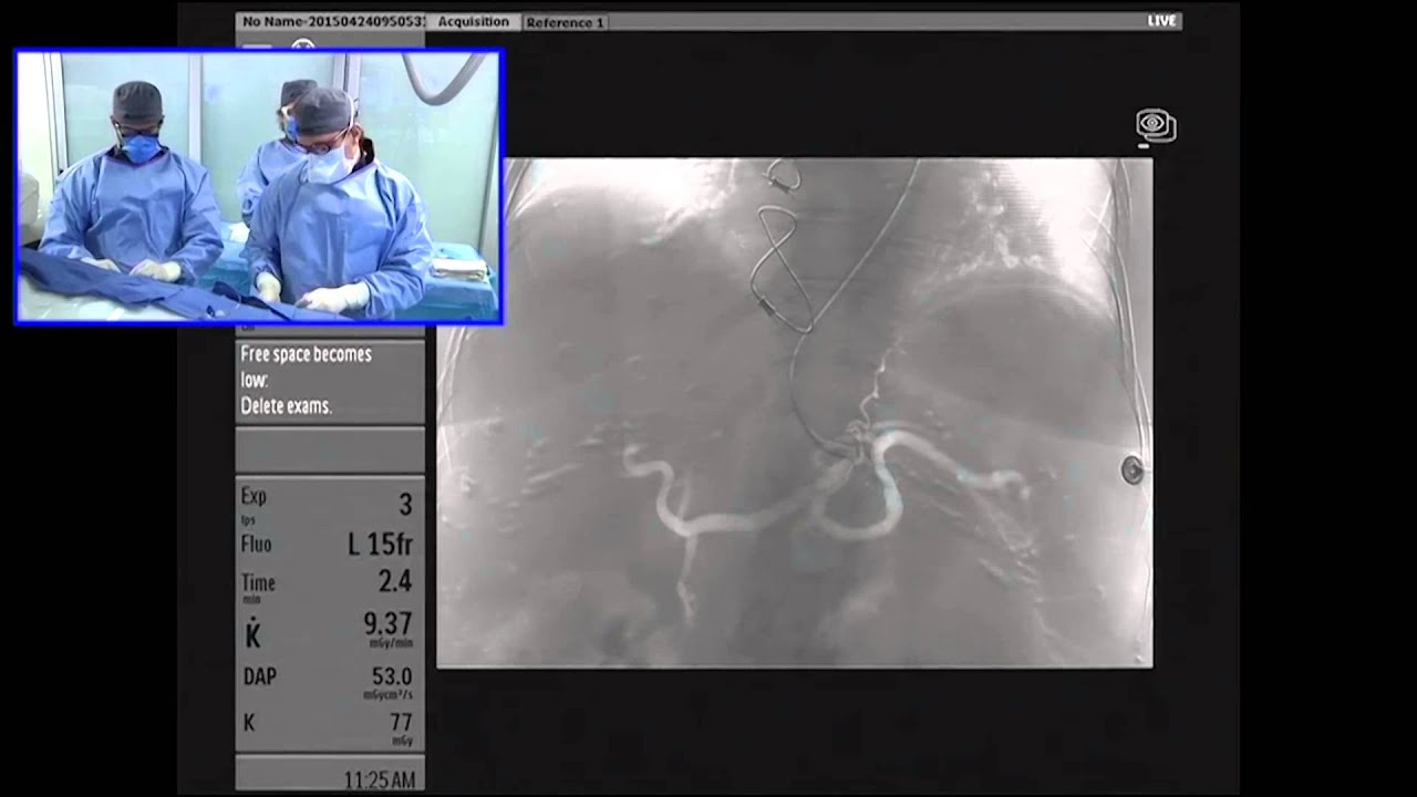 Transradial Angiography and Embolization prior to Y-90 Radioembolization