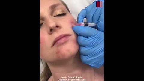 Profhilo BAP by Dr. Gabriel Siquier