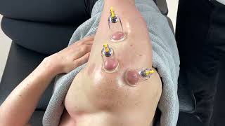 Myofascial Cupping - Shoulder