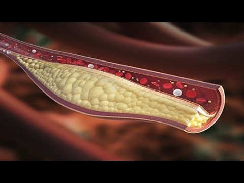 Video: Statiner Och Andra Läkemedel För Att Sänka Kolesterolet