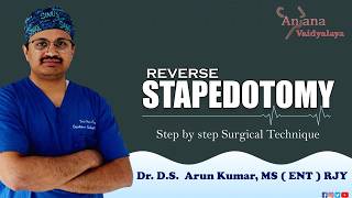 Reverse Stapedotomy| Dr DS Arun Kumar MS ENT