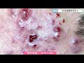 「枚桂」嚴重暗瘡皮膚處理7