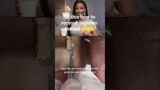 Ingrown Toenail Removal #shorts #ingrowntoenails
