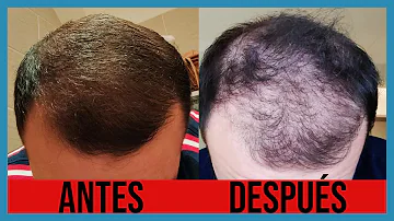 ¿Puedo dejar de tomar minoxidil?