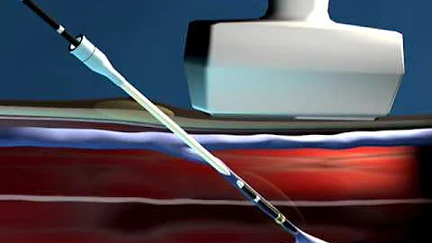 ClosureRFS Procedure