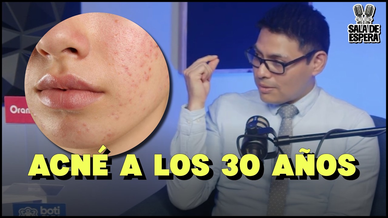 ¿Por qué te sale acné después de los 25 años? Hormonas y Estilo de Vida