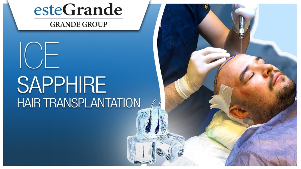 esteGrande Hair Transplant Journey Ice Sapphire Micro FUE Part 2