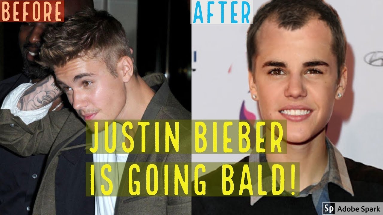 Justin Bieber Might Be Suffering From Some Hair Loss PICS