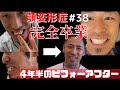 【顎変形症#38】4年半の治療ダイジェスト【ビフォーアフター】