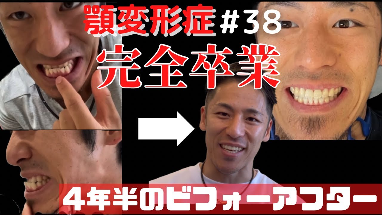 【顎変形症#38】4年半の治療ダイジェスト【ビフォーアフター】