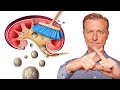 Clean Out Your Kidneys of Oxalates and Stones - Dr. Berg