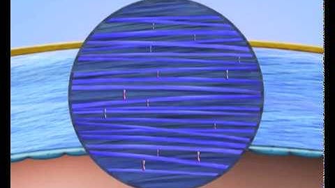 Contact Lens Assisted Collagen Crosslinking: A New Technique for Crosslinking in Thin Corneas