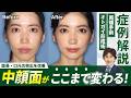 【骨切り】面長・口元の突出を改善し中顔面短縮！両顎手術の症例を徹底解説【リッツ美容外科】