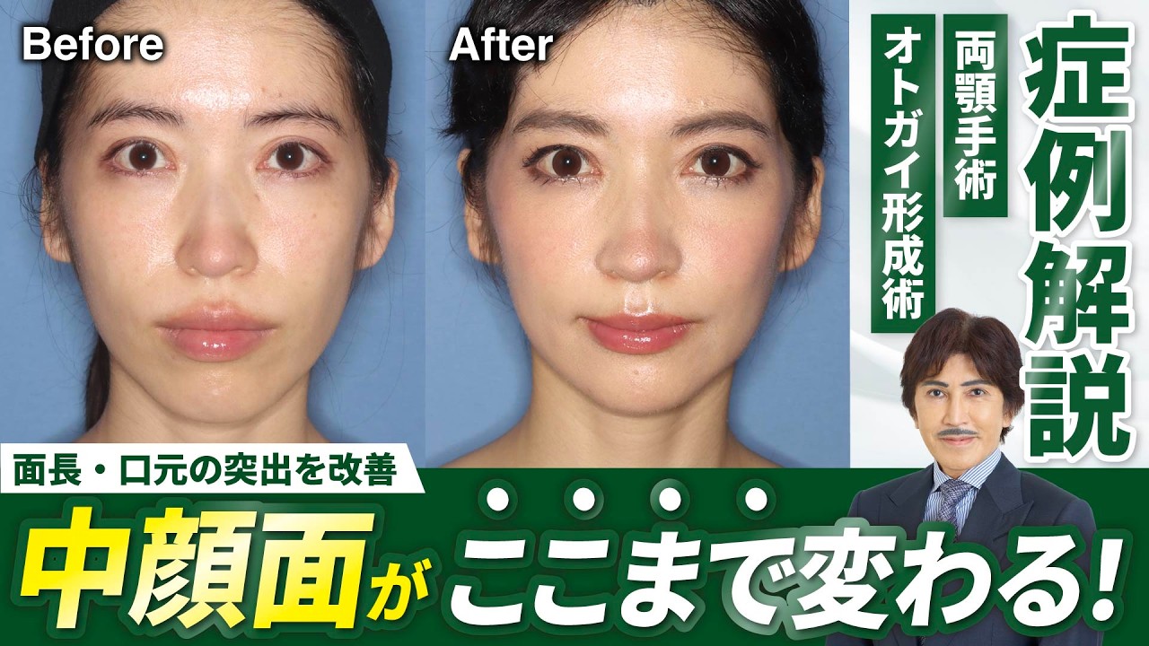 【骨切り】面長・口元の突出を改善し中顔面短縮！両顎手術の症例を徹底解説【リッツ美容外科】