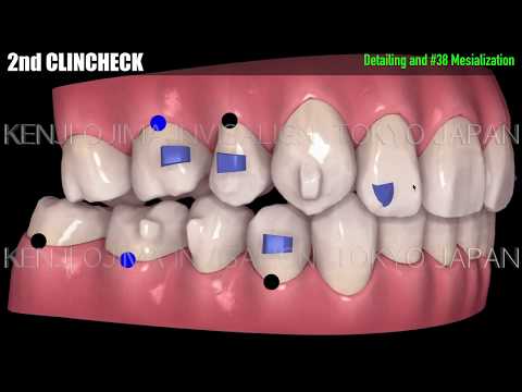 Invisalign Only Upper Premolars Extraction Approach【インビザライン抜歯のClass II div2】