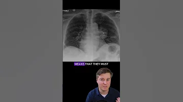 Hilum Overlay Sign Chest X Ray Interpretation Radiology Medicalstudent Radiologist 