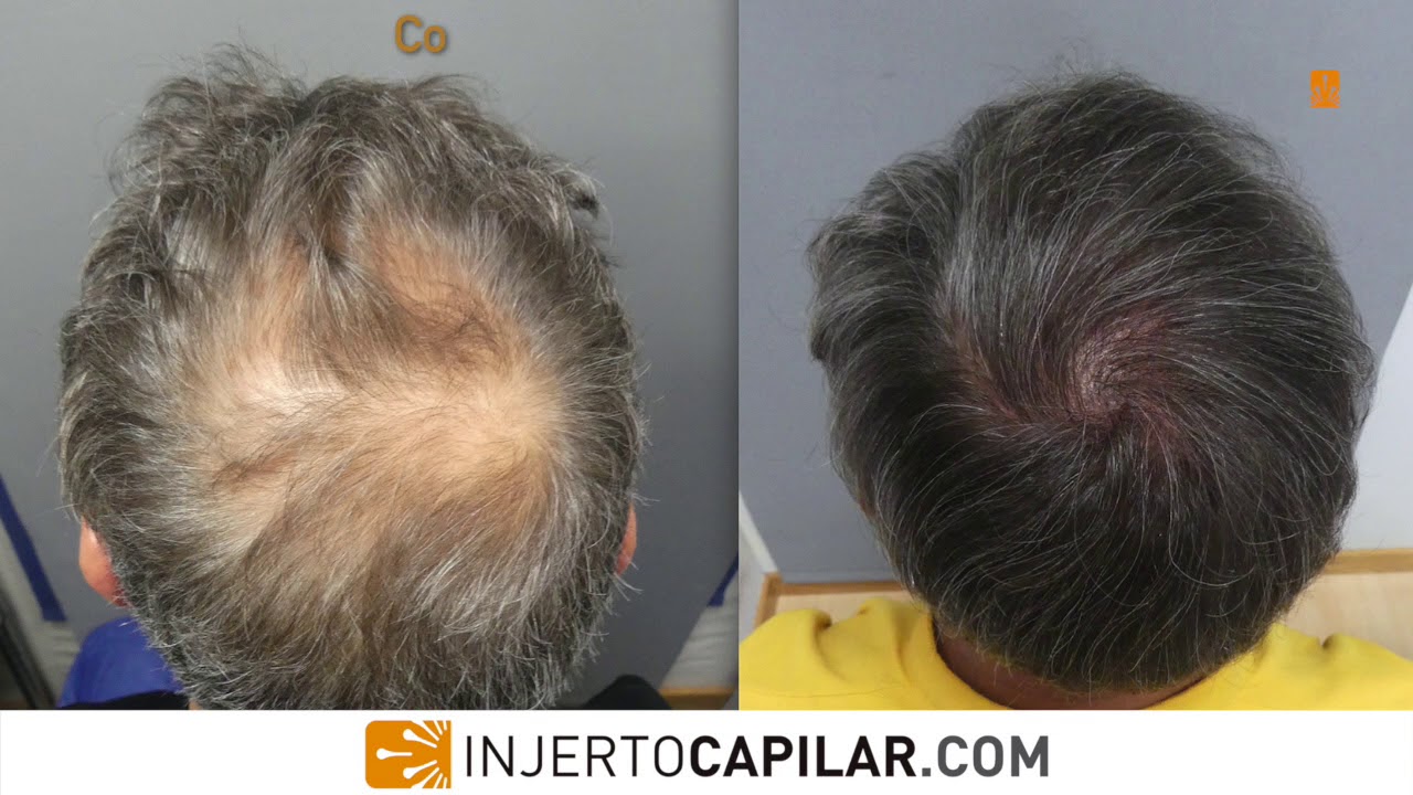 2801 Grafts Crown Restoration White Hair Early Regrowth