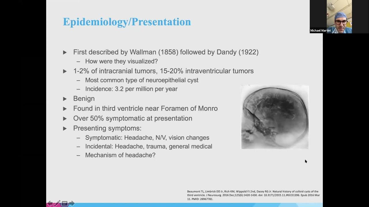 Surgical Management of Colloid Cysts with Alexander Schüpper, MD YouTube