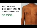 Secondary corrections in gynecomastia | Malayalam