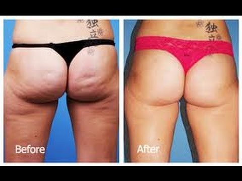 Cuantas veces hacer la máscara para los cabellos con la vitamina en 12 miel