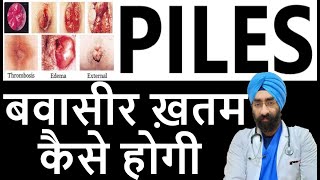PILES - The Most Simplified Explanation Dr Education Hindi Eng