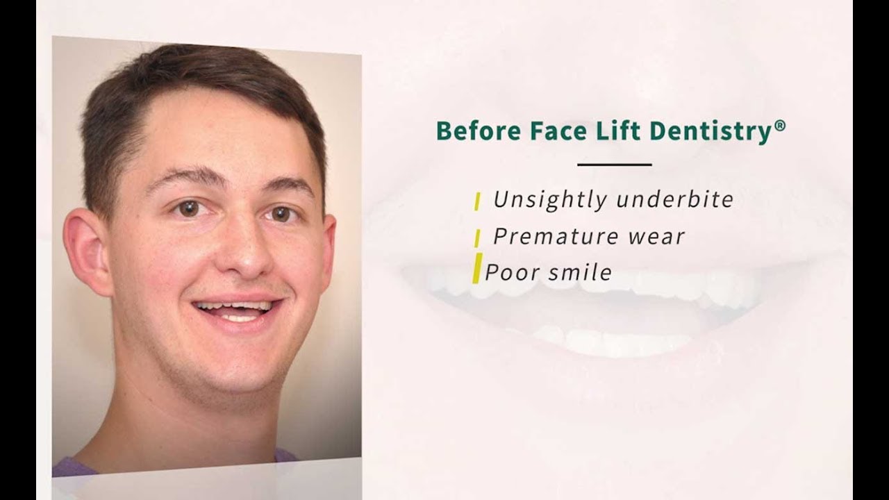 Underbite Jaw Surgery vs. Non-Surgical Underbite Correction no surgery rhinoplasty