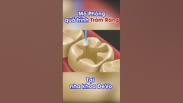 Hàn trám răng diễn ra như thế nào #shorts