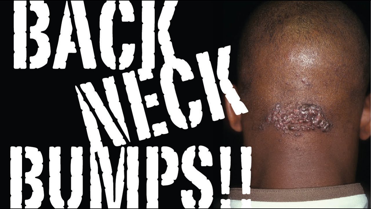 Back Neck Bumps Keloids The Cause The Cure Part One Youtube