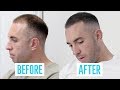 Hair loss solution - before and after