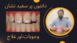 What are white spots on teeth | Causes and Treatment of white spots | Urdu Hindi