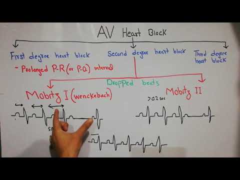 ቪዲዮ: በድመቶች ውስጥ የልብ ማገጃ (Mobitz Type I)