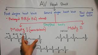 CVS physiology 49.Second degree heart block,Mobitz type 1(Wenckebach)& Mobitz type 2. Dropped beats