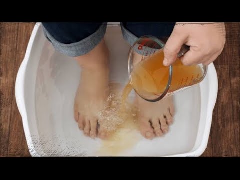 ماذا يحدث عند وضع قدمك في خل التفاح وكربونات الصوديوم