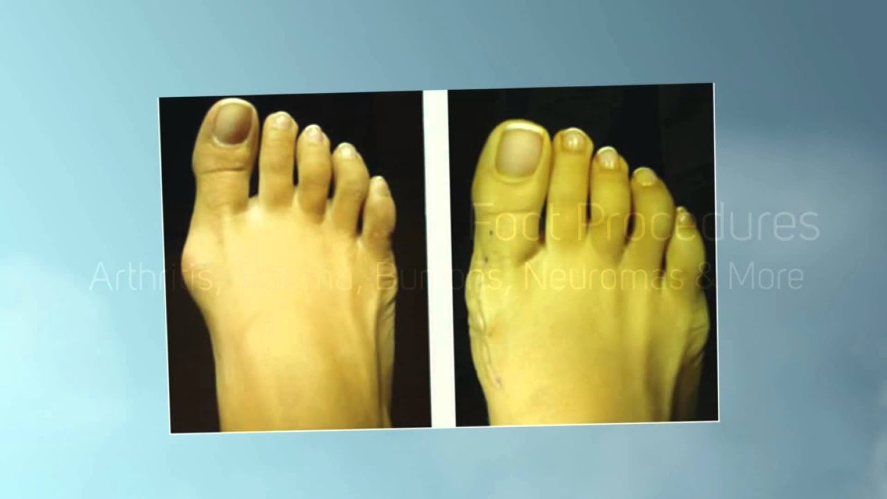 Best Podiatrist Boca Raton Florida YouTube