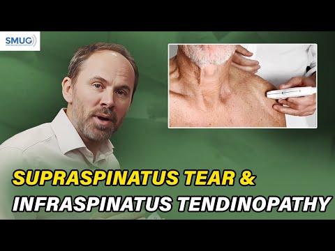 تمزق العضلة فوق الشوكة واعتلال وتر العضلة تحت الشوكة لا تفوتوا هذه الفرصة مرة أخرى