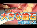 【歯石除去】大きな歯石が取れました🦷【Big tartar have removed】【去除较大牙石】