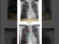 Tension pneumothorax #pneumothorax