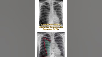Tension pneumothorax #pneumothorax